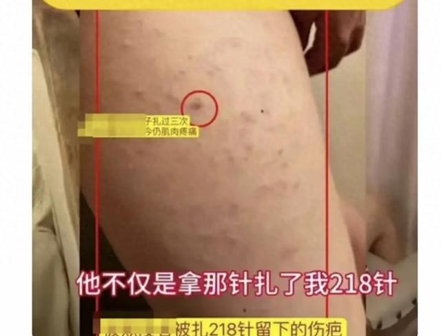 山东一女生，被同桌男生用锥子在腿上扎成了马蜂窝