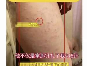 美女扎腿间(山东一女生，被同桌男生用锥子在腿上扎成了马蜂窝)