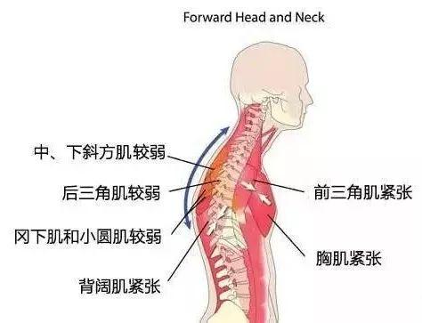 脖子前倾毁了无数人！除了最毁气质，健康危害也不少！